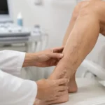 Avaliação vascular de varizes com ultrassom em Cuiabá para definir o tratamento adequado