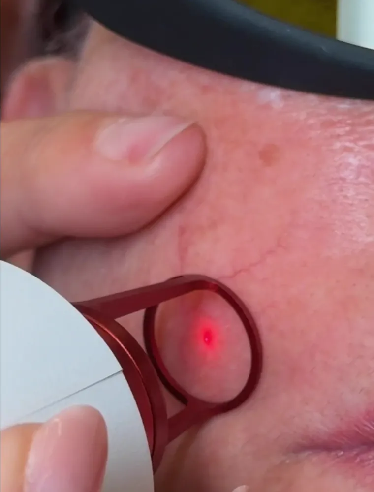 Aplicação do Laser Transdérmico no rosto sobre vasinho facial em Cuiabá