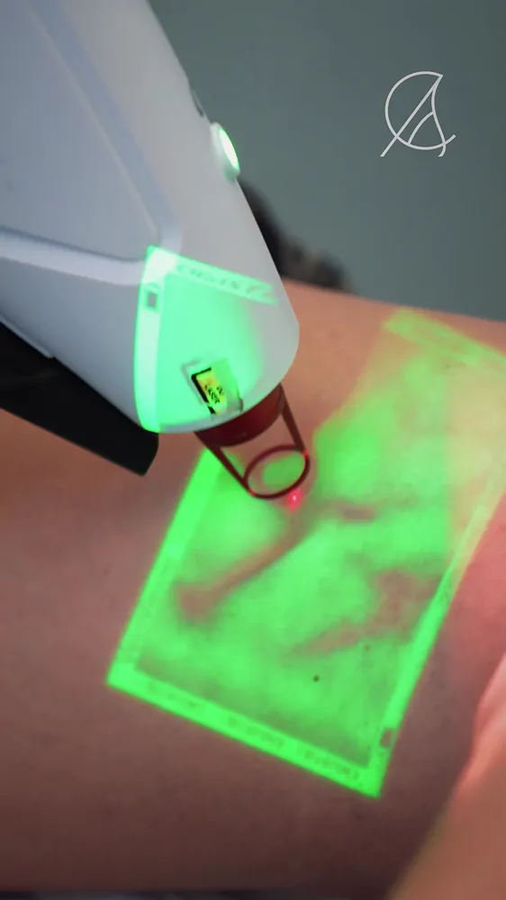 Laser Transdérmico tratando vasinhos nas pernas em Cuiabá