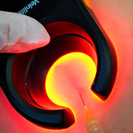 Escleroterapia com espuma densa para varizes em Cuiabá
