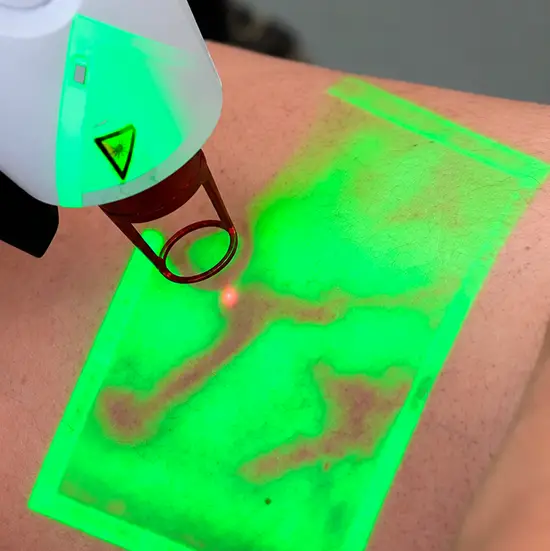 Tratamento de vasinhos com laser transdérmico em Cuiabá